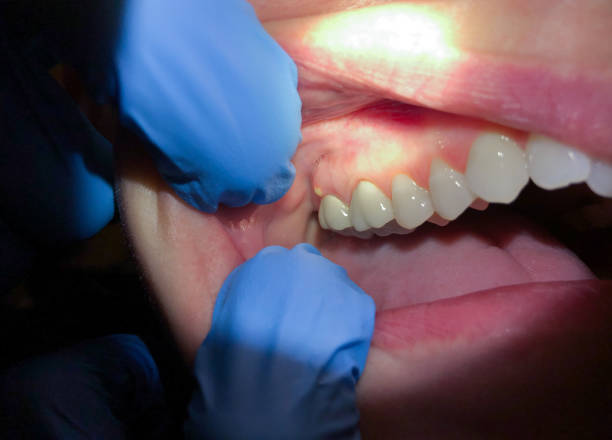 Best Emergency Care for Gum Disease in West Hamburg, PA